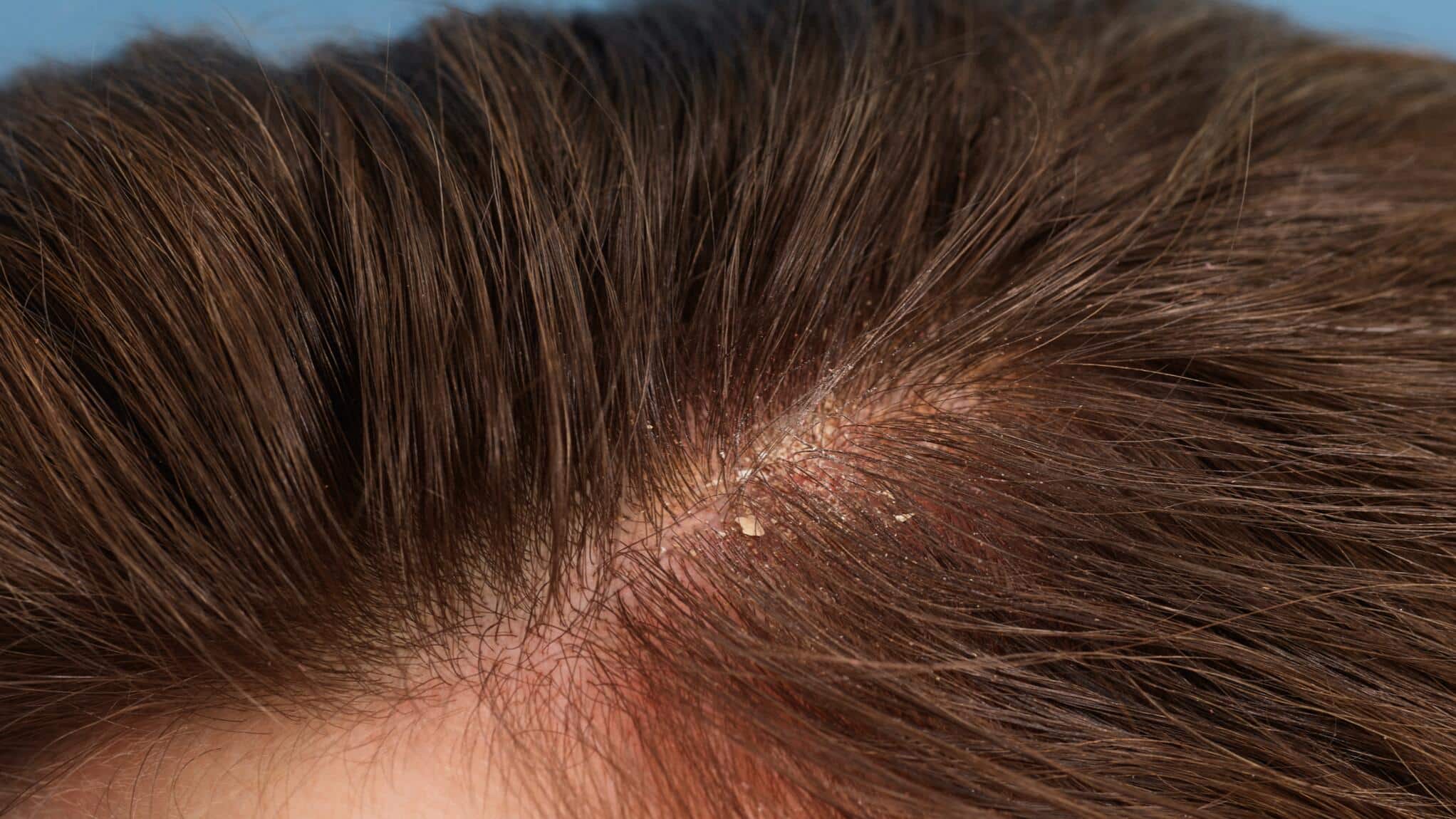 Cuir chevelu irrité avec squames jaunâtres
