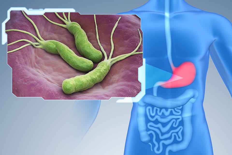 Schéma d'Helicobacter pylori dans l'estomac
