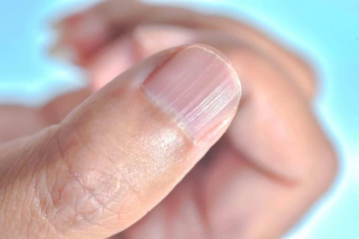 Ongles avec stries verticales
