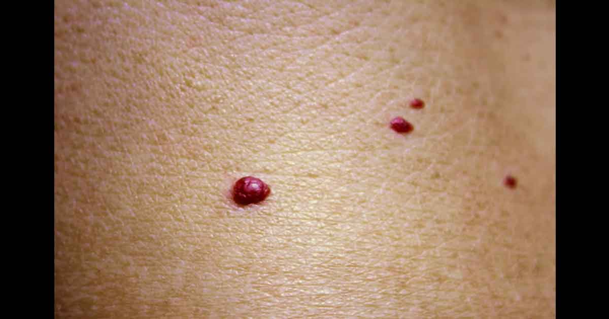 Angiomes cerises sur le torse