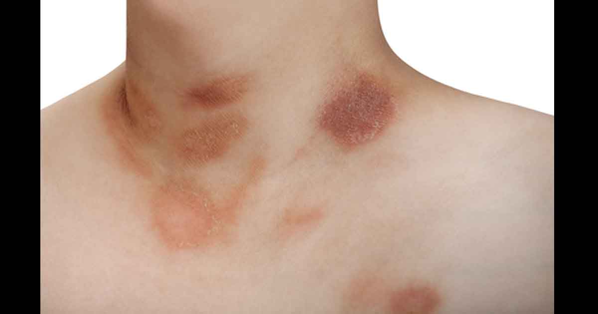 Pityriasis rosé sur le torse