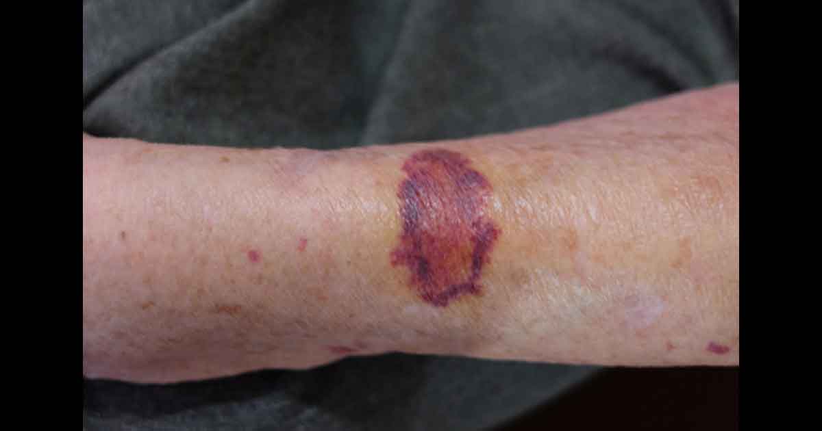 Taches de purpura sur les jambes