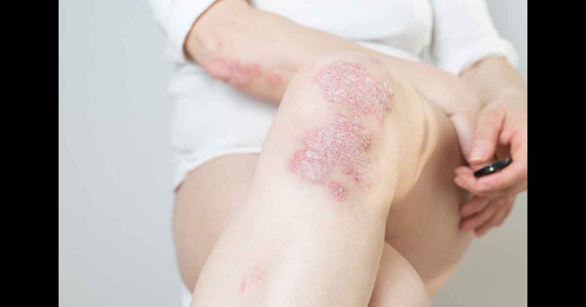 Plaques de psoriasis sur le coude