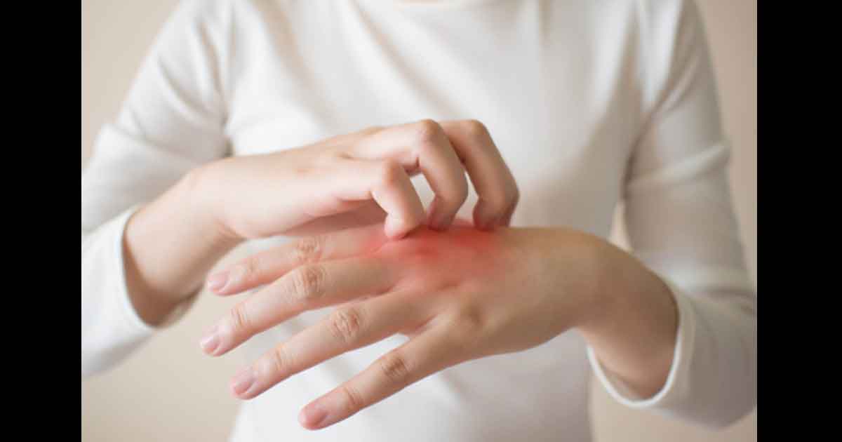 Réaction cutanée à un médicament