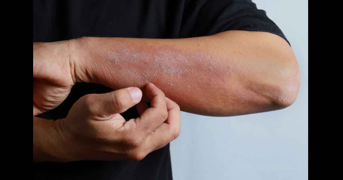 Plaques d'eczéma sur les mains