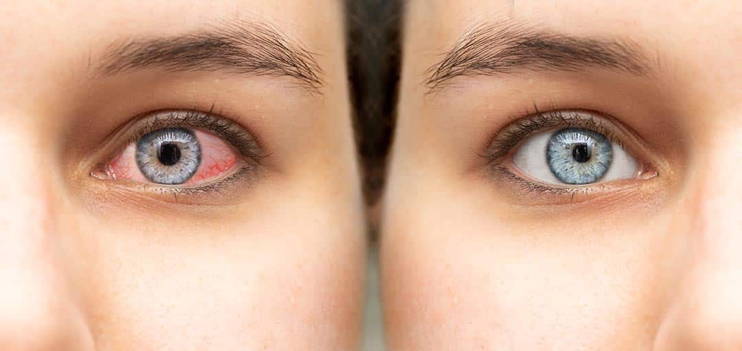 yeux rouges