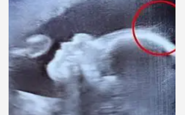 &Eacute;chographie montrant un f&oelig;tus avec une chevelure visible