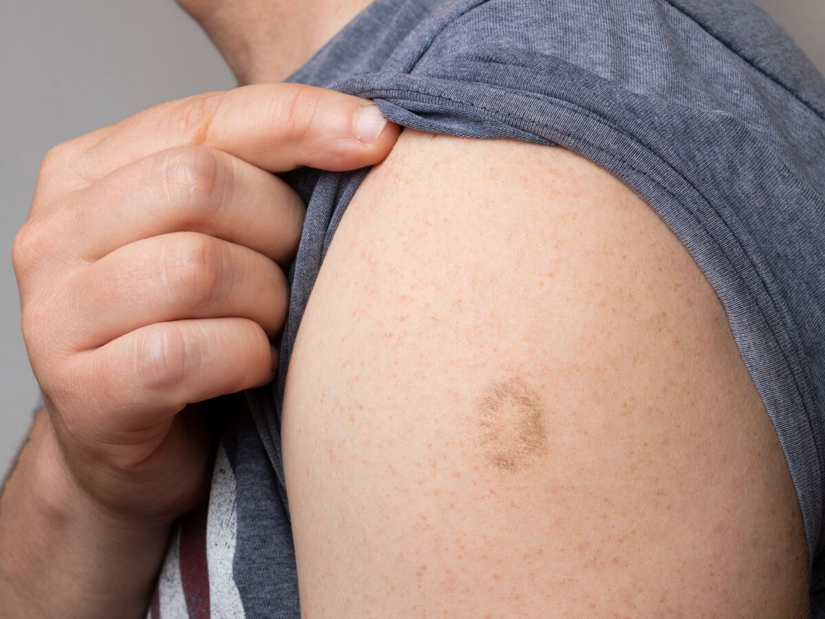 Cicatrice de vaccination typique