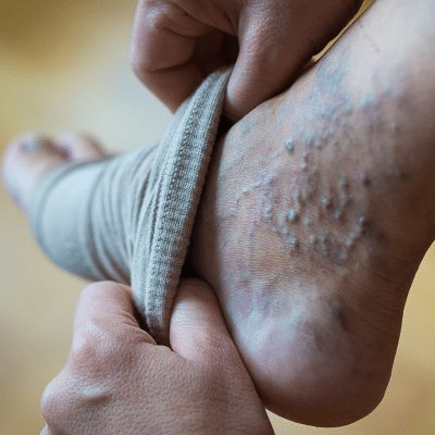 Conseils contre les varices