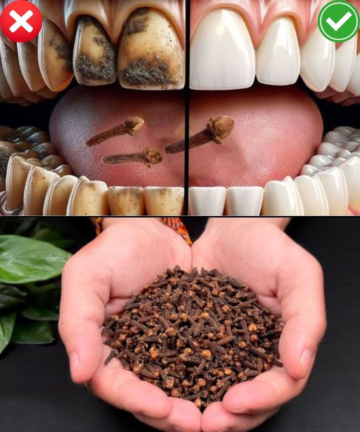 Clous de girofle, une &eacute;pice aux vertus bucco-dentaires