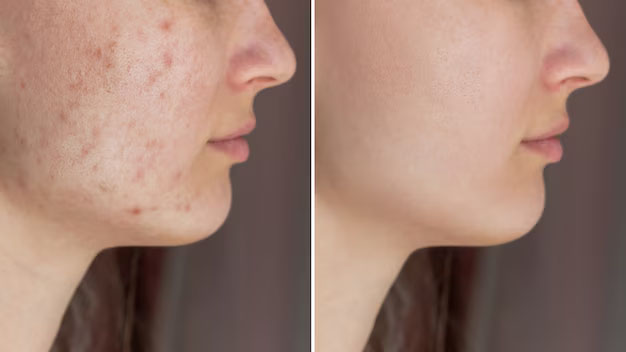 Comparaison avant/après traitement naturel