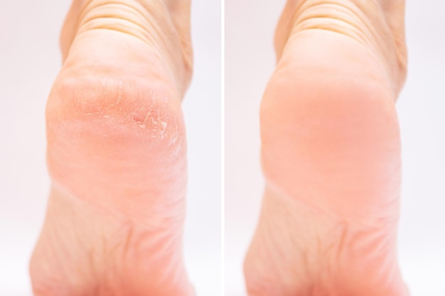 Comparaison avant/après soin des pieds