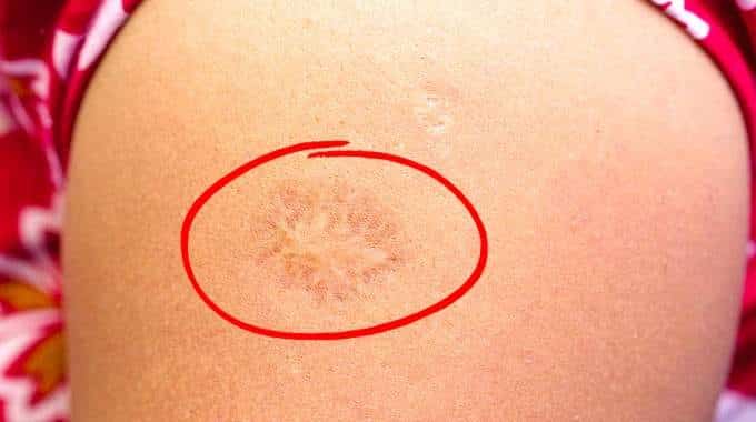 Examen de la cicatrice vaccinale