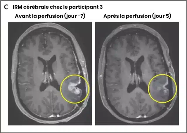 Graphique montrant la régression tumorale après traitement