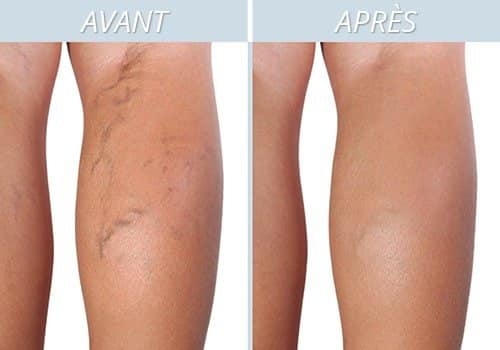 Jambes présentant des varices