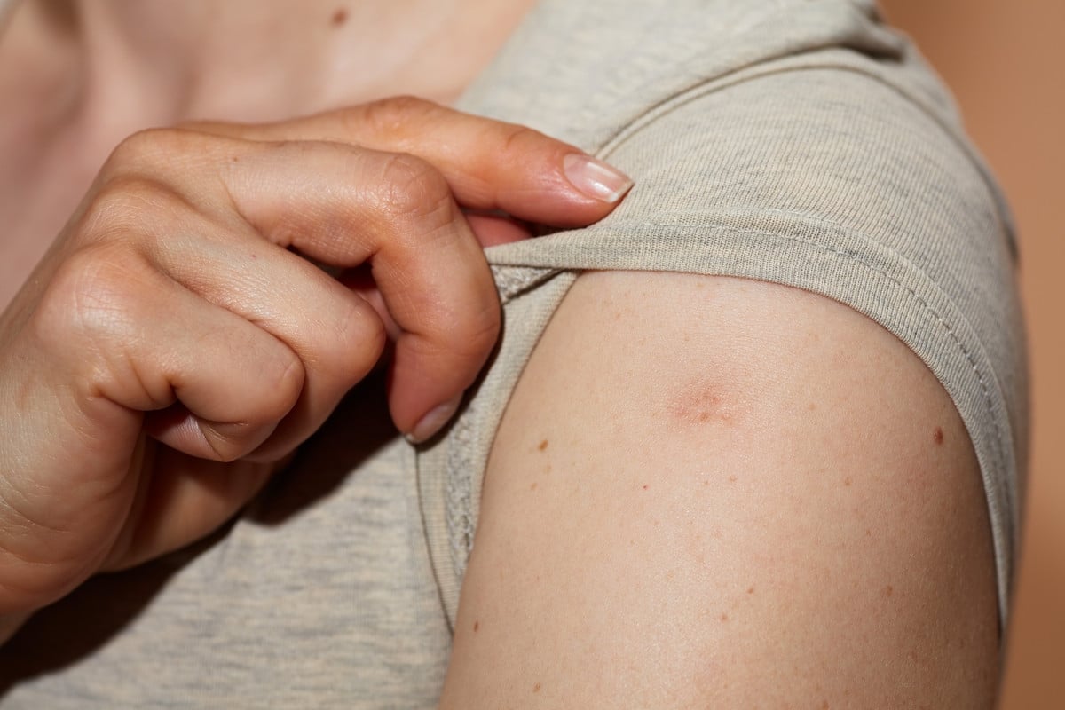 Technique de vaccination contre la variole