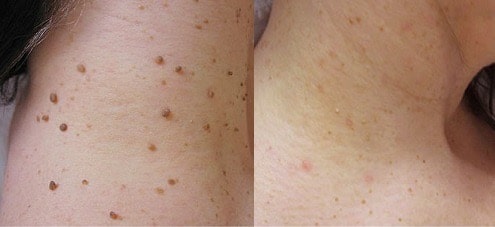 Comparaison avant/après traitement